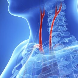 services-carotid-262x333 services-carotid-262x333